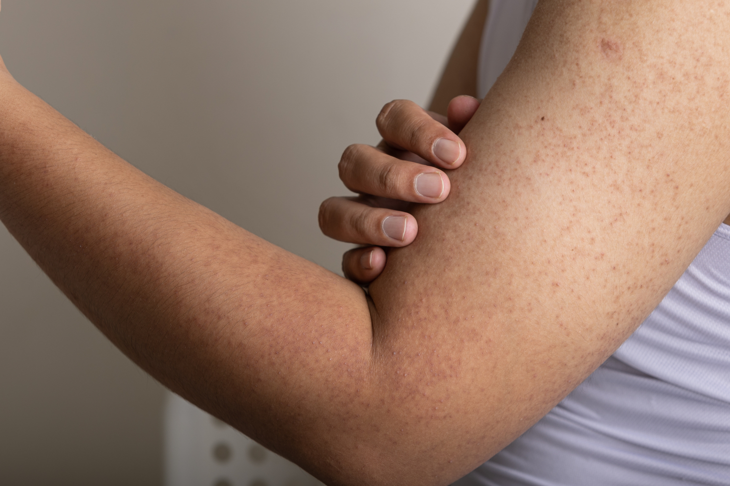 Understanding Keratosis Pilaris: Causes, Symptoms, and Treatments